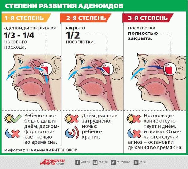 Симптомы аденоидита у детей