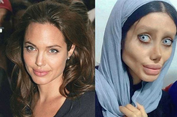 Анджелина Джоли и пластика лица