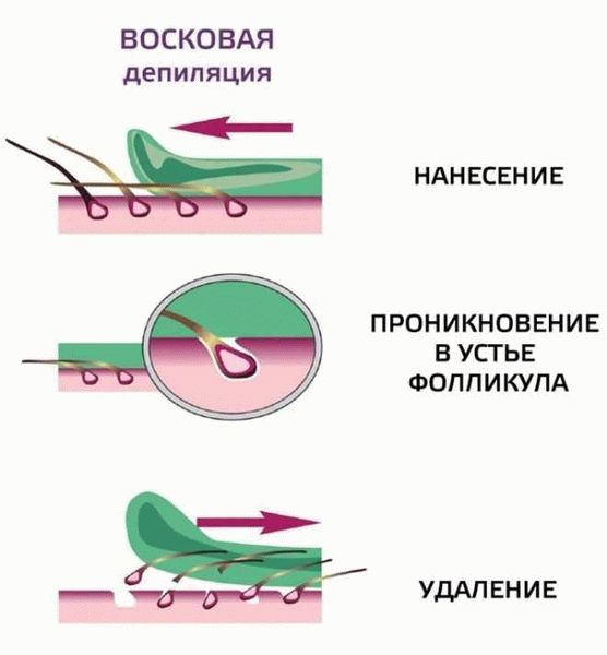 Другие способы классической и глубокой депиляции