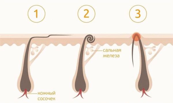 Как предотвратить врастание волос в интимной зоне при использовании бритвы