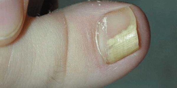 Причины отслаивания ногтя и восстановления