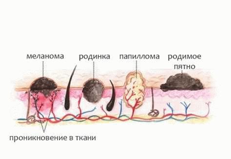 Как отличить папиллому от родинки