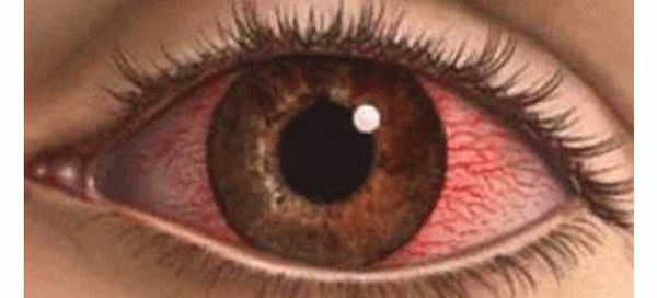 Меры профилактики для предотвращения химических ожогов глаза
